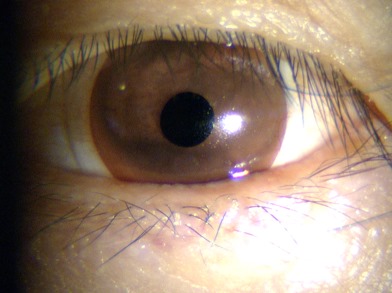 abnormal cornea after wearing iris prosthetic soft contact lens contact lens contact lens