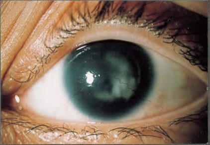 Aniridia before wearing iris prosthetic soft contact lens contact lens contact lens