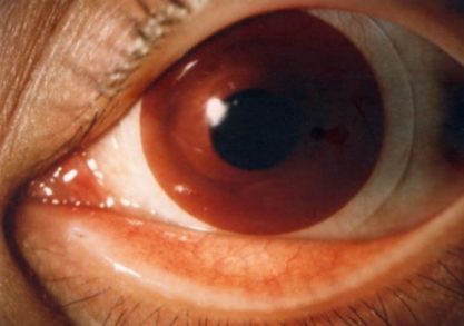 cornea opacity after wearing iris prosthetic soft contact lens contact lens contact lens