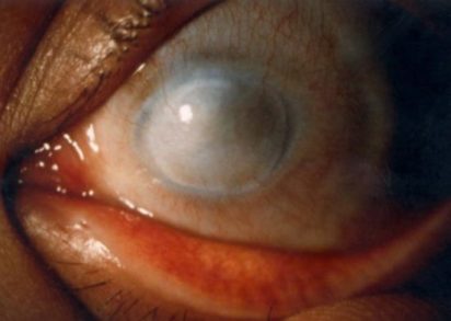 cornea opacity before wearing iris prosthetic soft contact lens contact lens contact lens